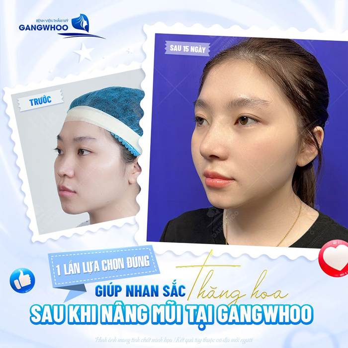 Nâng mũi S Line có được vĩnh viễn không? Thời gian duy trì tối đa bao lâu?