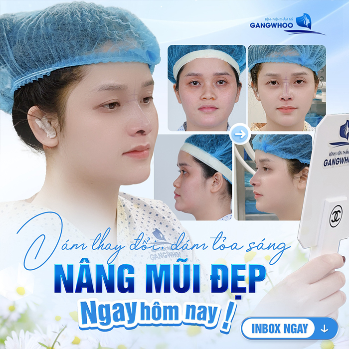 Nâng mũi S Line có được vĩnh viễn không? Thời gian duy trì tối đa bao lâu?