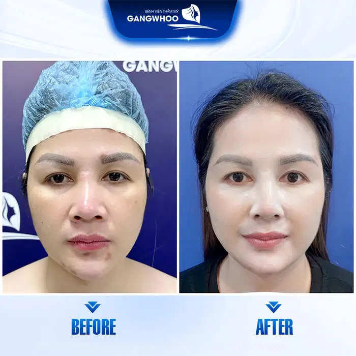 Nâng mũi sau 1 năm bị sưng có nguy hiễm không? Cách xử lý như thế nào?