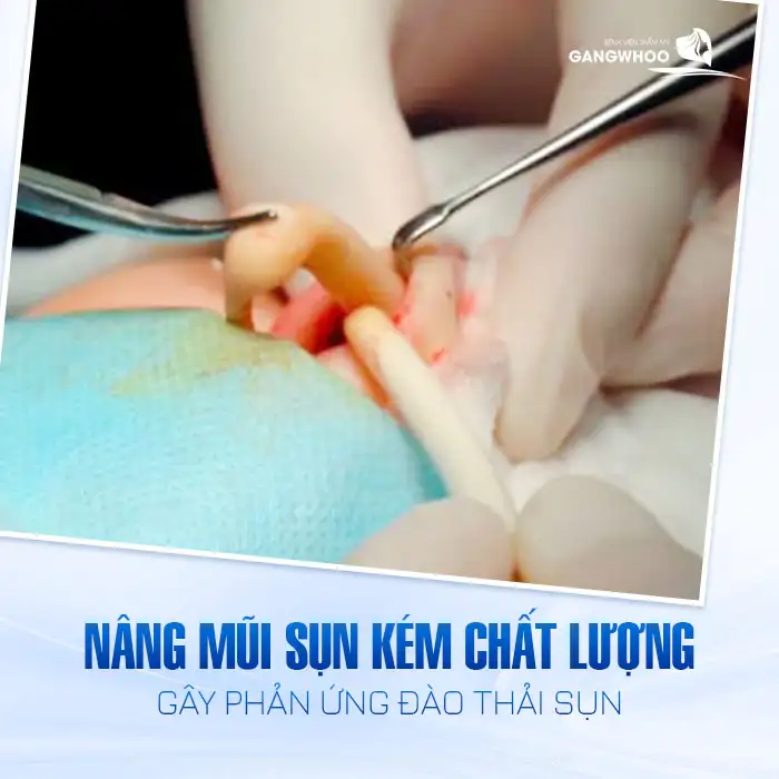 Nâng mũi sau 1 năm bị sưng có nguy hiễm không? Cách xử lý như thế nào?