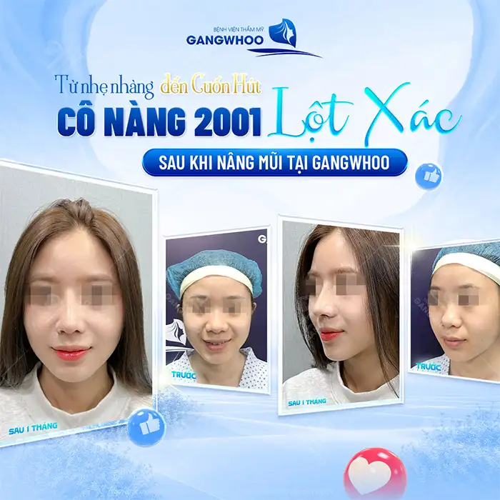 Nâng mũi Silicon được bao lâu? Duy trì được vĩnh viễn không?