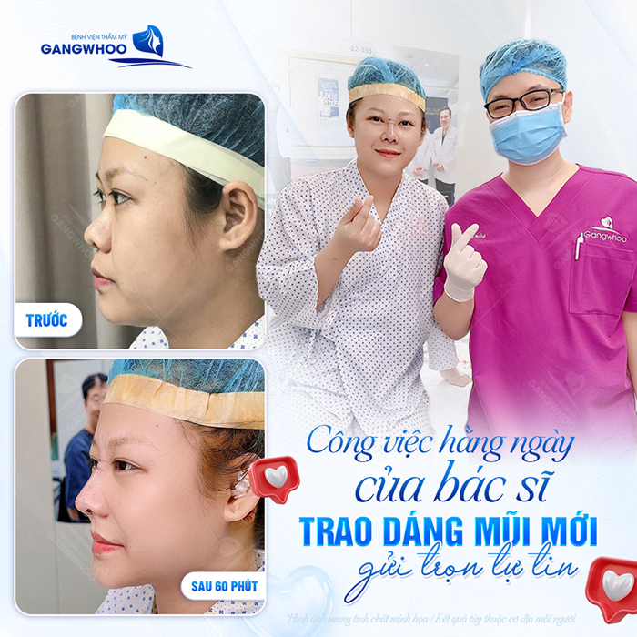 Nâng mũi sụn tự thân có vĩnh viễn không? Các yếu tố quyết định đến độ bền