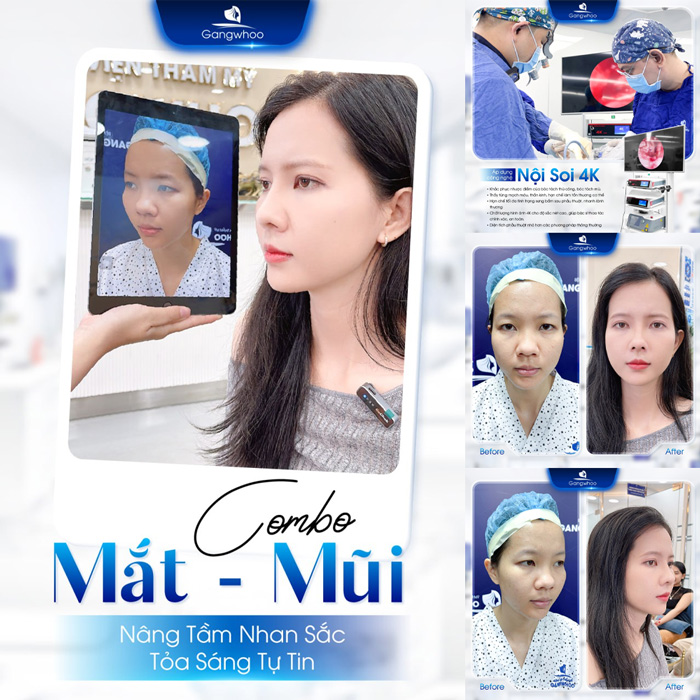 Có nên nâng mũi và cắt mí cùng lúc không? Có gây ảnh hưởng gì không?