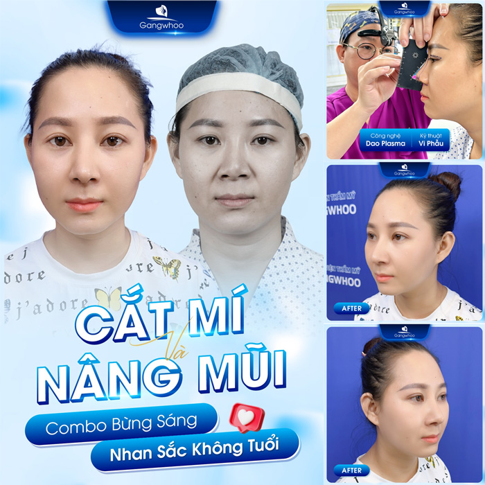 Có nên nâng mũi và cắt mí cùng lúc không? Có gây ảnh hưởng gì không?