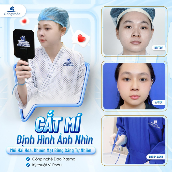 Có nên nâng mũi và cắt mí cùng lúc không? Có gây ảnh hưởng gì không?