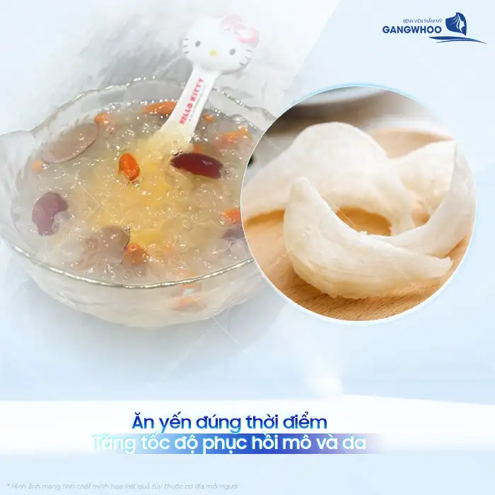 Nâng mũi ăn yến được không? Những lưu ý khi sử dụng