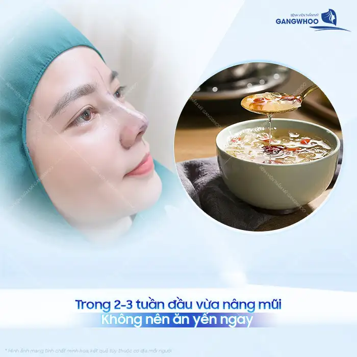 Nâng mũi ăn yến được không? Những lưu ý khi sử dụng