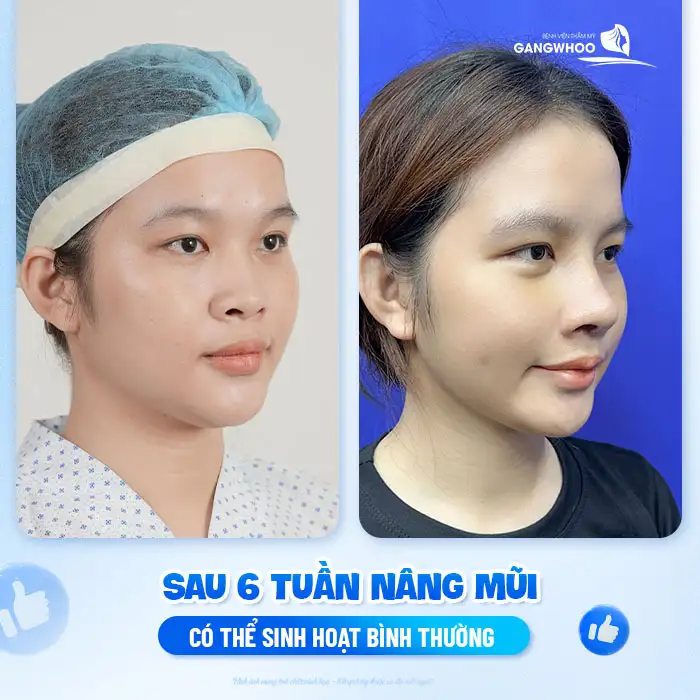 Nâng mũi xong có quan hệ được không? Có cần phải kiêng