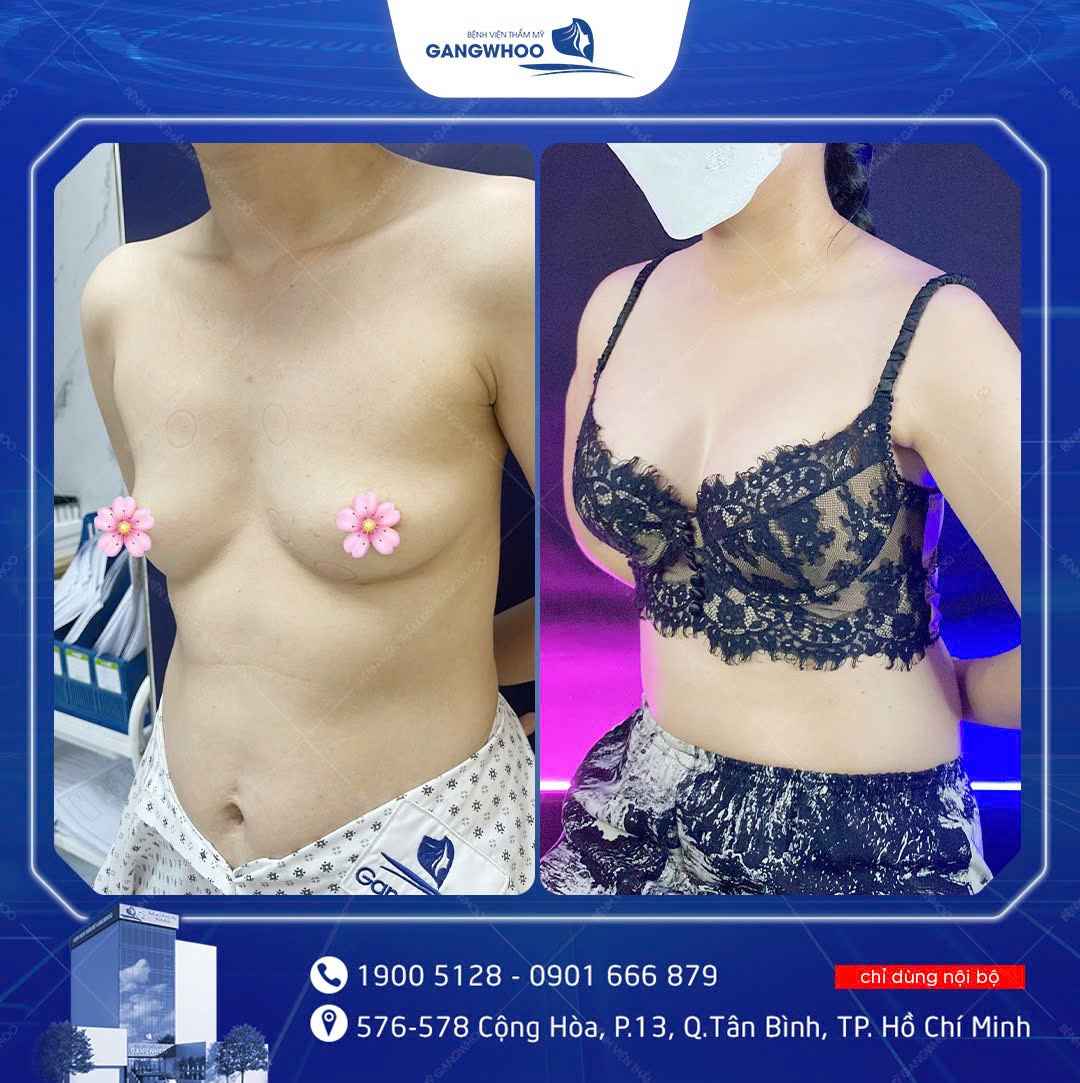 Nâng Ngực Tại Gangwhoo – Kiến Tạo Vòng 1 Hoàn Mỹ, An Toàn & Tự Nhiên 7 Hình ảnh khách nâng ngực Tại Gangwhoo