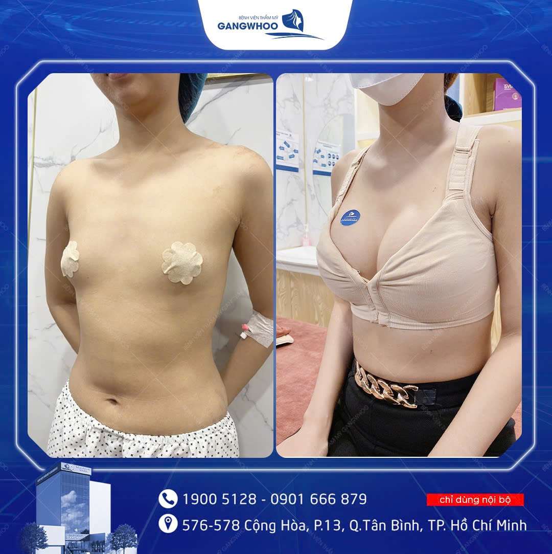 Nâng Ngực Tại Gangwhoo – Kiến Tạo Vòng 1 Hoàn Mỹ, An Toàn & Tự Nhiên 8 Hình ảnh khách nâng ngực Tại Gangwhoo