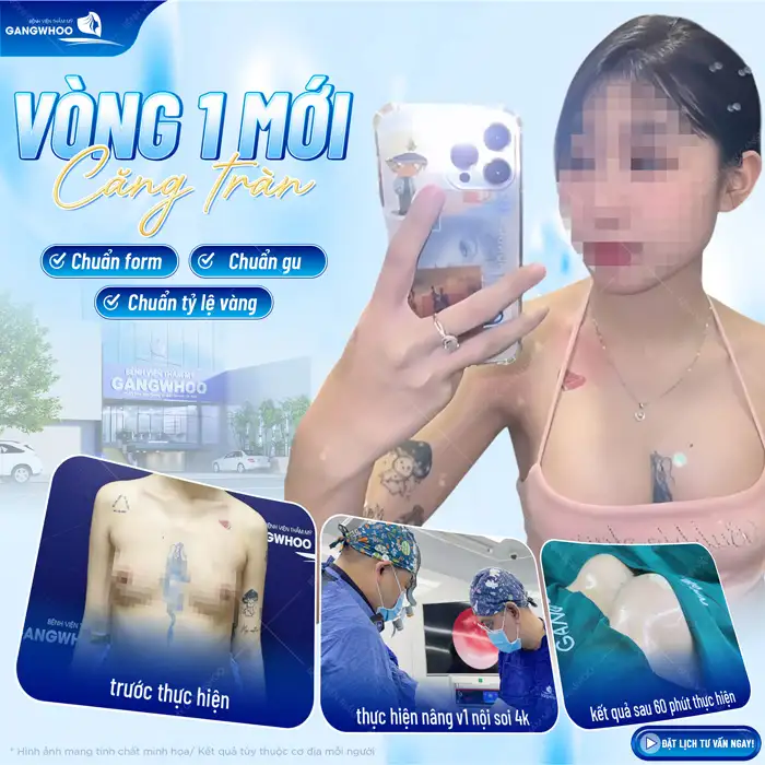 Nâng ngực bằng chất làm đầy có an toàn không? Nguy cơ tiềm ẩn là gì?