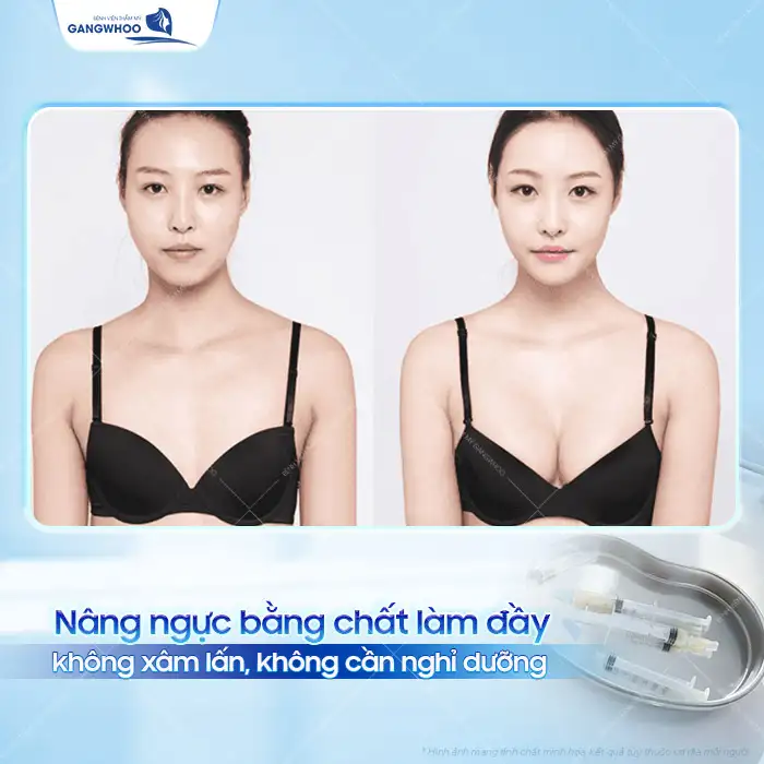 Nâng ngực bằng chất làm đầy có an toàn không? Nguy cơ tiềm ẩn là gì?