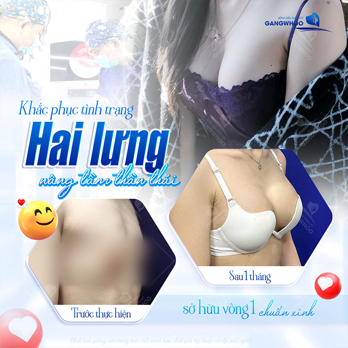 Nâng ngực bằng mỡ tự thân được bao lâu? Cách chăm sóc sau khi thực hiện