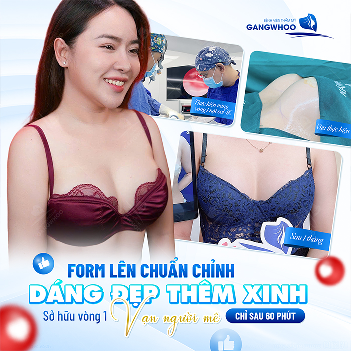 Nâng ngực bằng cấy mỡ tự thân giá bao nhiêu? Bảng giá mới nhât 2025