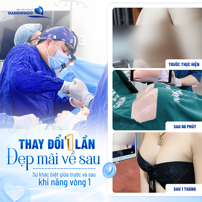 Nâng ngực bằng cấy mỡ tự thân giá bao nhiêu? Bảng giá mới nhât 2025