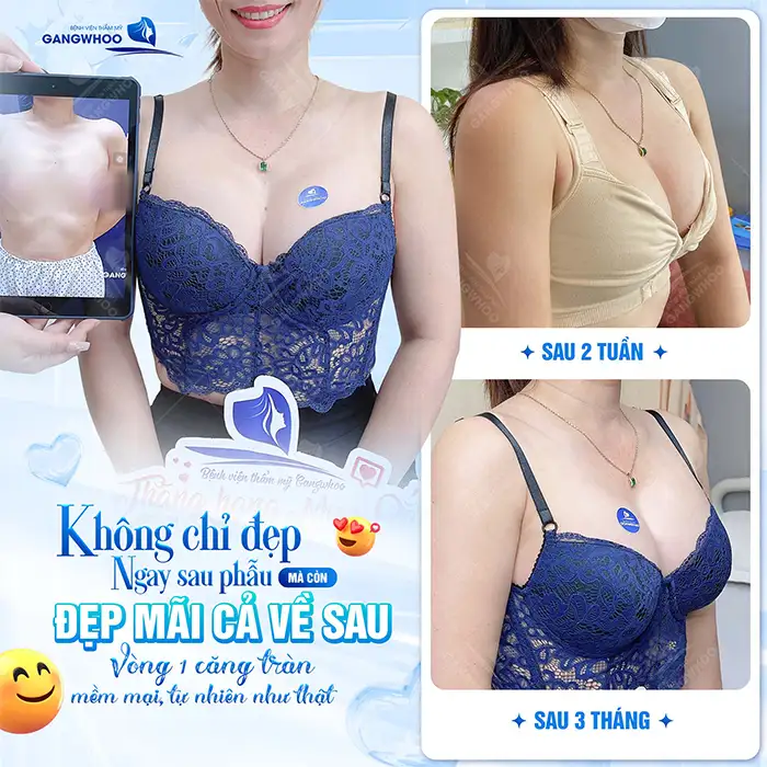 Nâng ngực bằng túi Gel là gì? Có tốt và an toàn không?