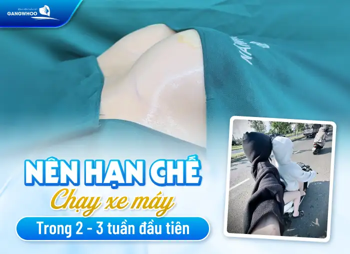 Sau nâng ngực bao lâu được đi xe máy? Cần lưu ý gì?