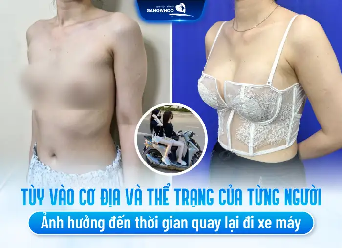 Sau nâng ngực bao lâu được đi xe máy? Cần lưu ý gì?