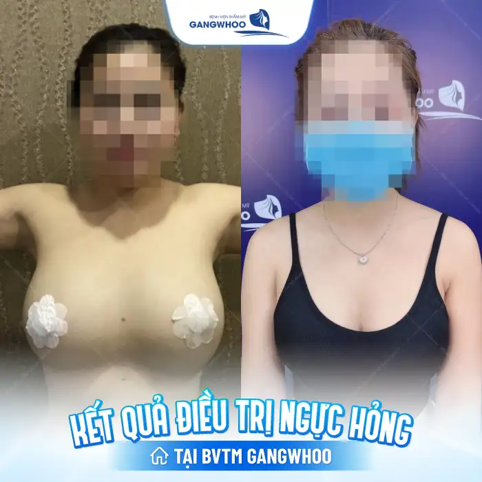 Nâng ngực bị hỏng có khắc phục được không? Thực hiện ra sao