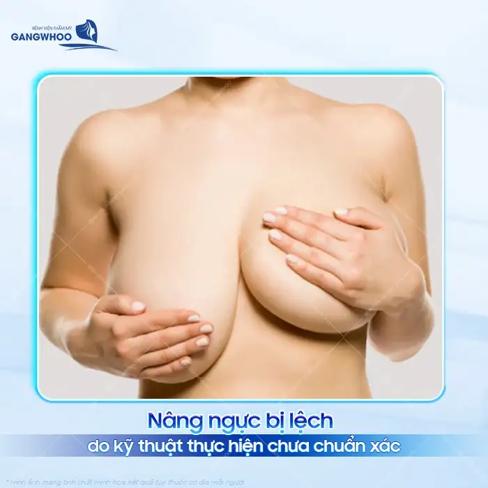 Nguyên nhân nâng ngực bị lệch là gì? Cách khắc phục ra sao?