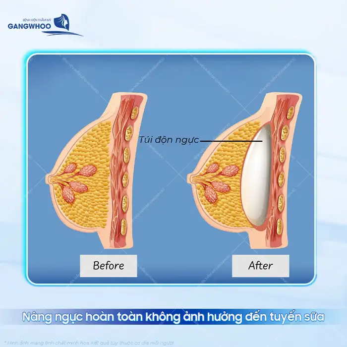 Nâng ngực cho con bú có bị xệ không? Cách cho con bú đúng cách