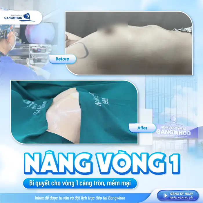 Nâng ngực cho nam giới là gì? Có gì khác so với nâng ngực nữ giới