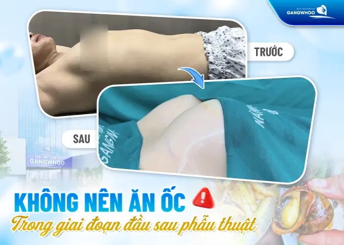 Nâng ngực có được ăn ốc không? Vì sao cần kiêng ăn ốc