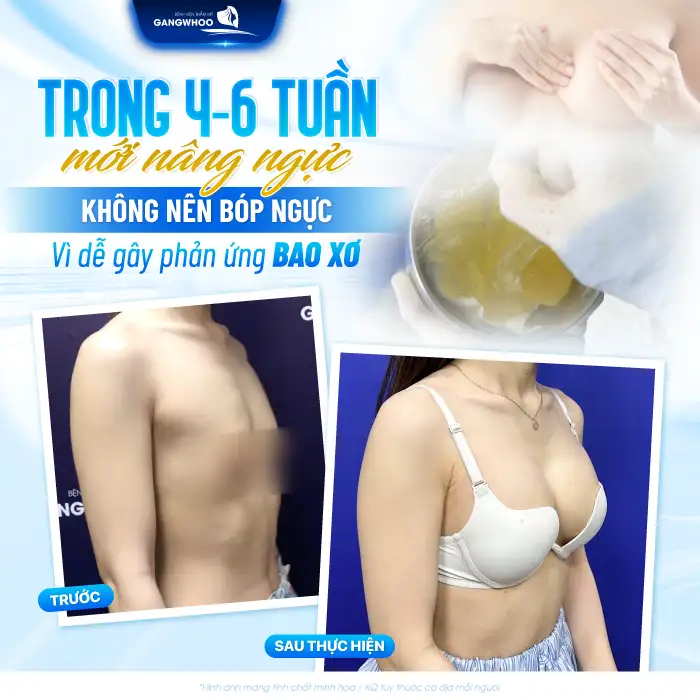 Ngực nâng có bọp được không? Bao lâu thì được bóp