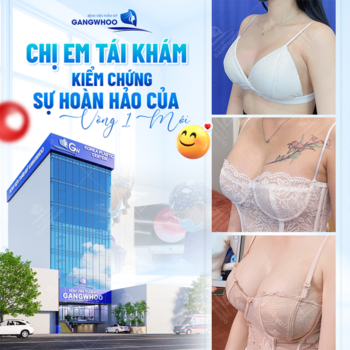 Nâng ngực có được vĩnh viễn không? Thời gian duy trì bao lâu?