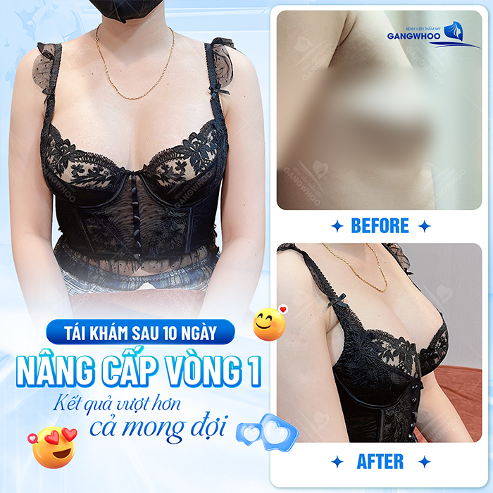 Có nên nâng ngực bằng túi nano chip không? Ưu, nhược điểm ra sao