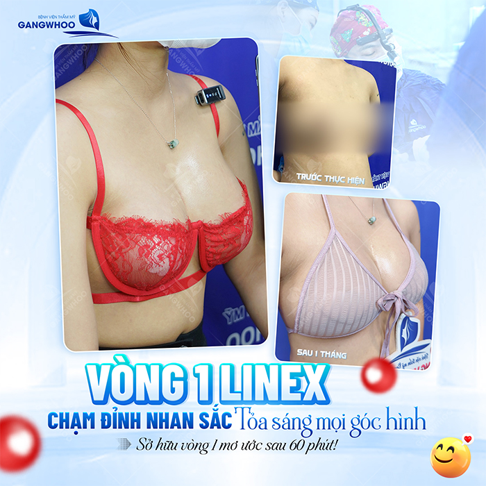 Có nên nâng ngực bằng túi nano chip không? Ưu, nhược điểm ra sao