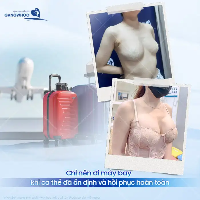 Nâng ngực có đi máy bay được không? Liệu có bị nổ khi đi máy bay