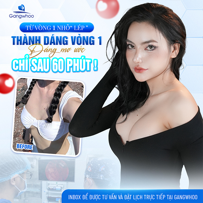 Nâng ngực đường chân ngực là gì? Phù hợp với những ai?