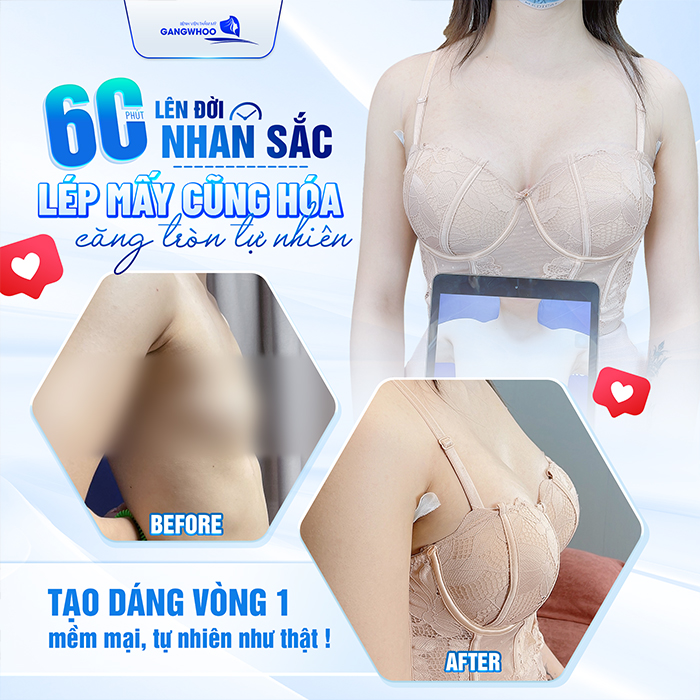 Nâng ngực đường chân ngực là gì? Phù hợp với những ai?