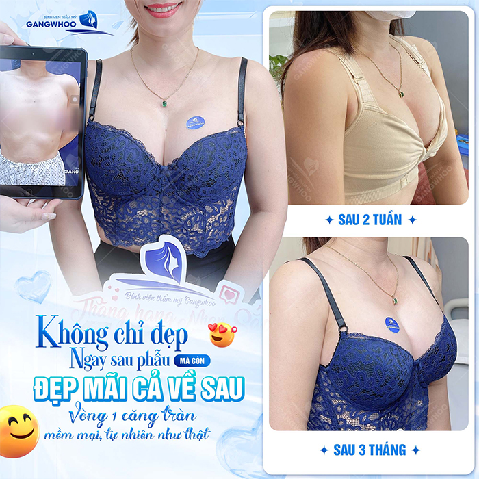 Nâng ngực đường nách là gì? Quy trình thực hiện ra sao?