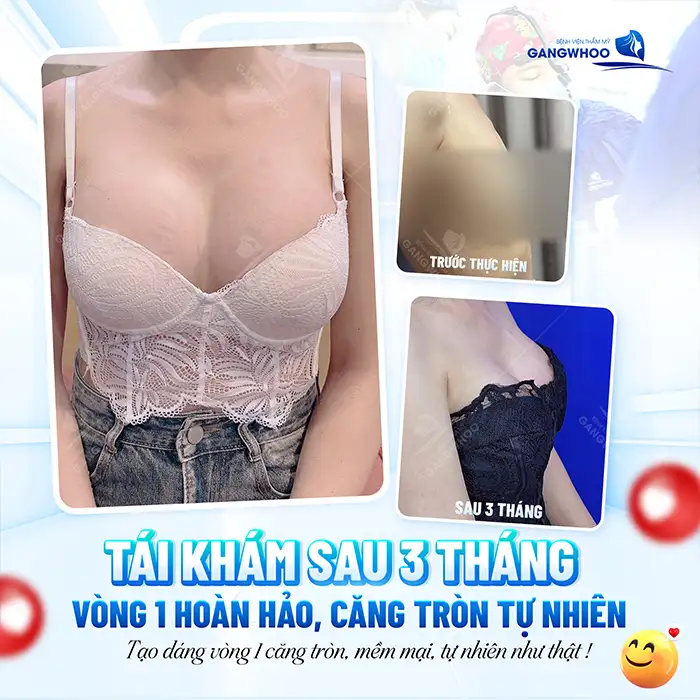 Nâng ngực đường quầng có cho con bú được không? Có gây ảnh hưởng gì không?