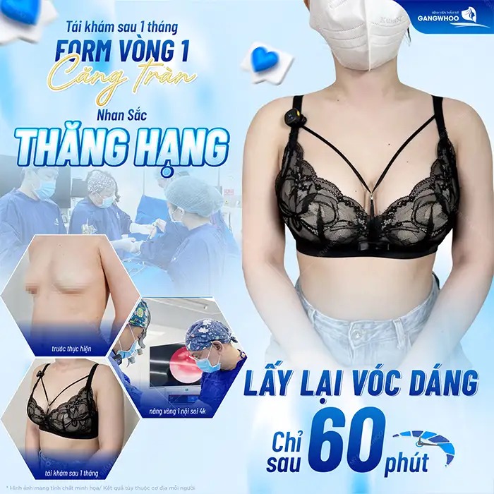 Phương pháp nâng ngực Hàn Quốc là gì? Ưu, nhược điểm của nâng ngực Hàn Quốc