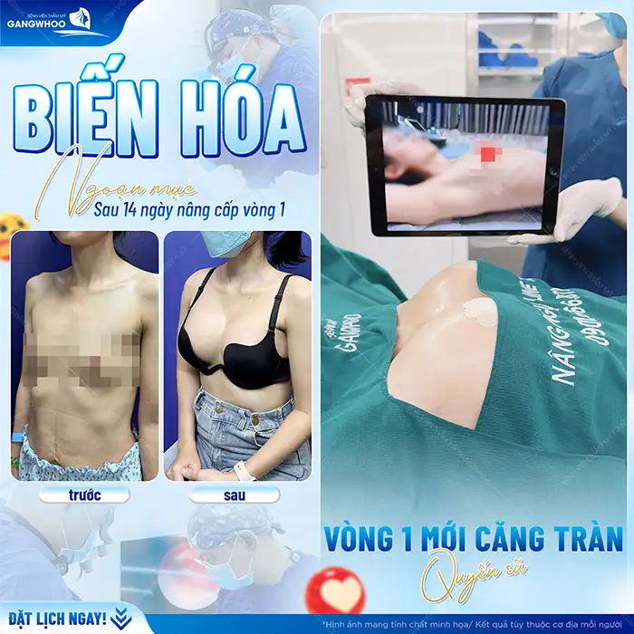Phương pháp nâng ngực Hàn Quốc là gì? Ưu, nhược điểm của nâng ngực Hàn Quốc