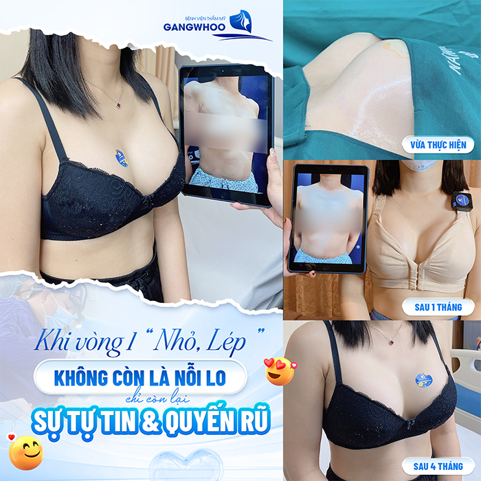 Nâng ngực nội soi qua đường rốn là gì? Có đảm bảo an toàn không?