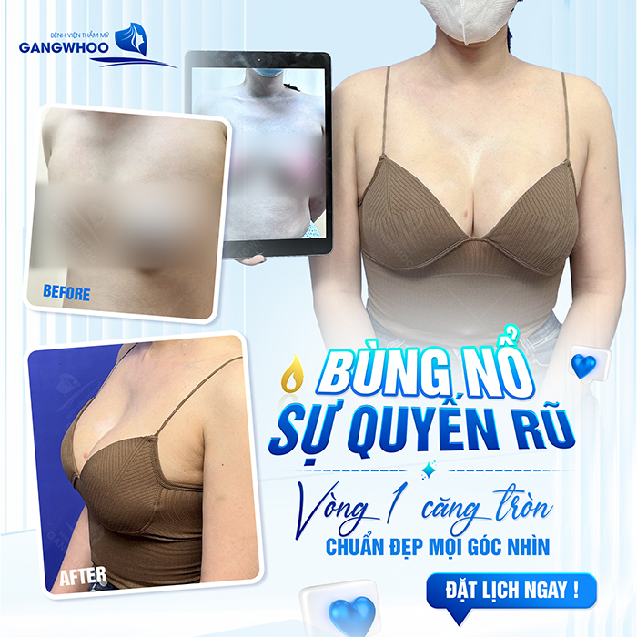 Nâng ngực sa trễ là như thế nào? Có bao nhiêu phương pháp treo sa trễ