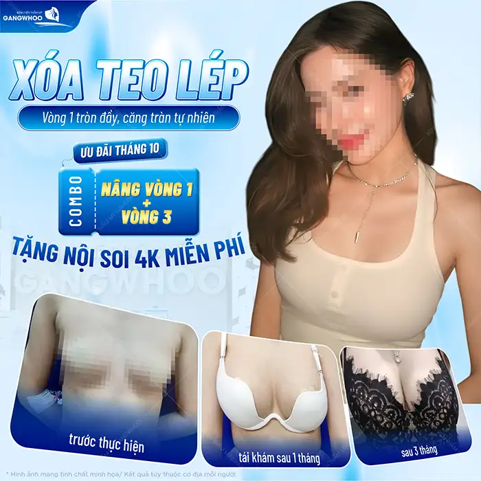 Có nên nâng ngực size 250 không? Phù hợp với ai?