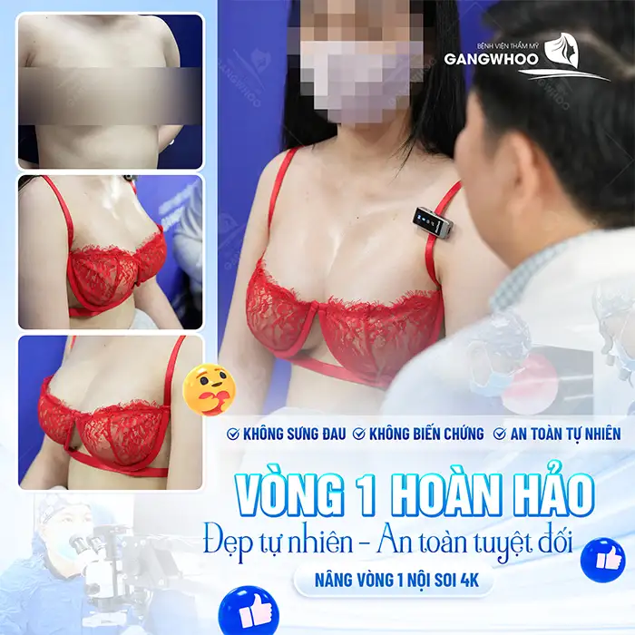 Nâng ngực size 360 là gì? Những điều cần lưu ý trước khi nâng