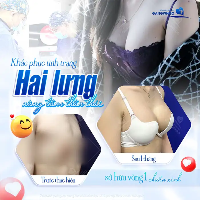 Nâng ngực size 360 là gì? Những điều cần lưu ý trước khi nâng
