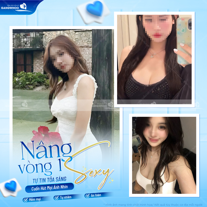 Nâng ngực size bao nhiêu thì đẹp? Hướng dẫn cách chọn size túi nâng