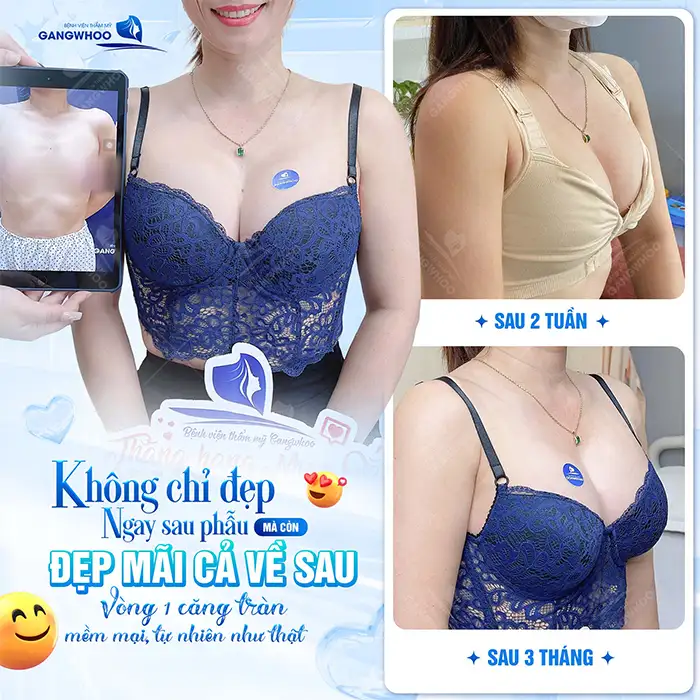 Nâng ngực size nhỏ nhất là bao nhiêu? Những ai phù hợp để nâng size nhỏ