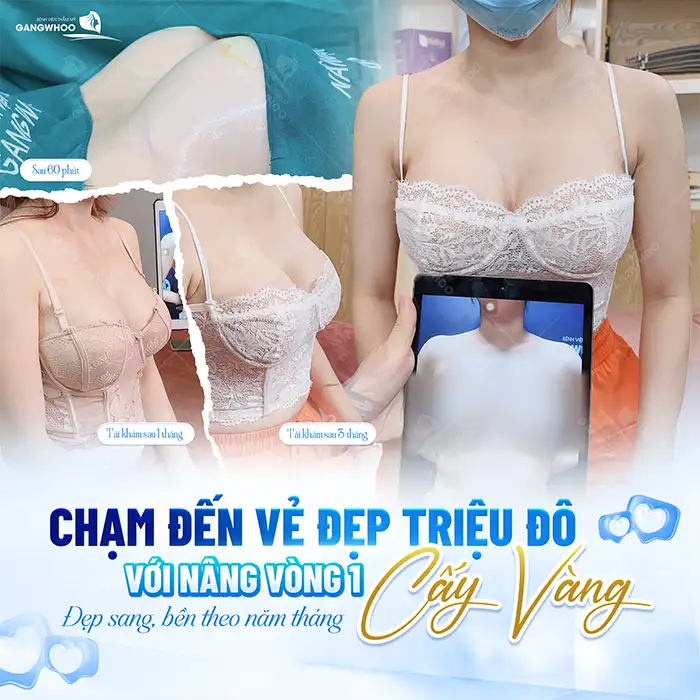 Nâng ngực size nhỏ nhất là bao nhiêu? Những ai phù hợp để nâng size nhỏ