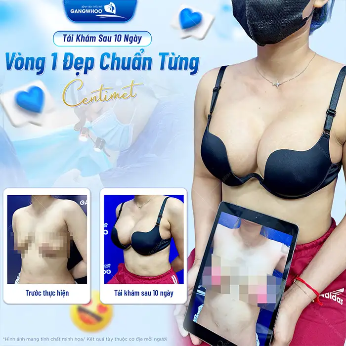 Nâng ngực túi nano không chip là gì? Có nên nâng không?