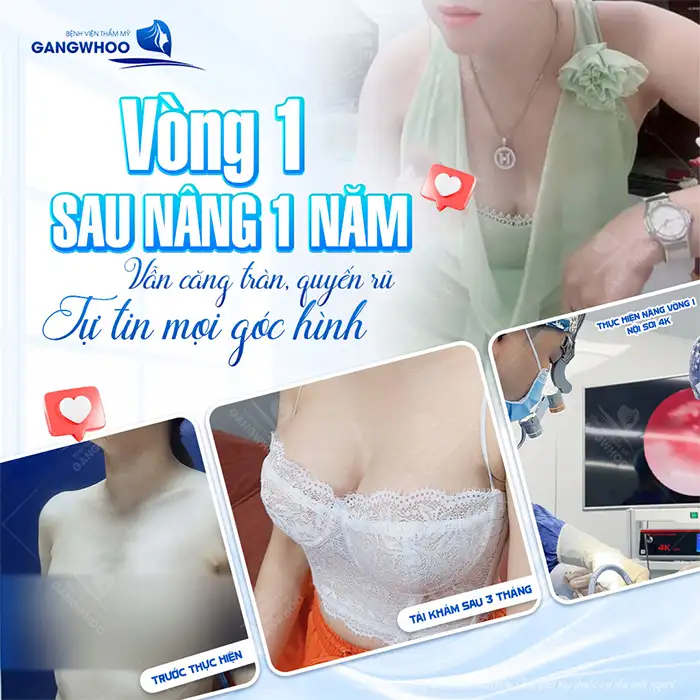 Nâng ngực túi nano không chip là gì? Có nên nâng không?