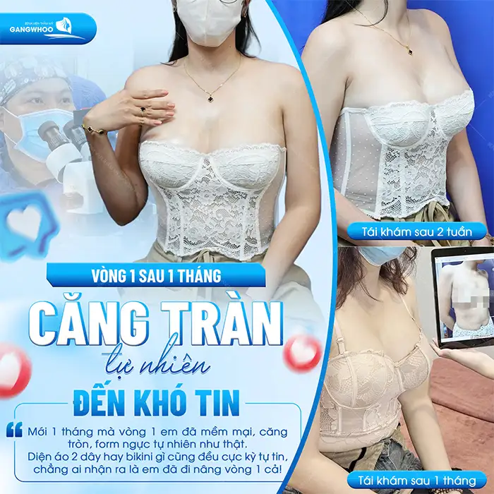 Nâng ngực túi nhám là gì? Nên chọn đặt túi nhám hay túi trơn