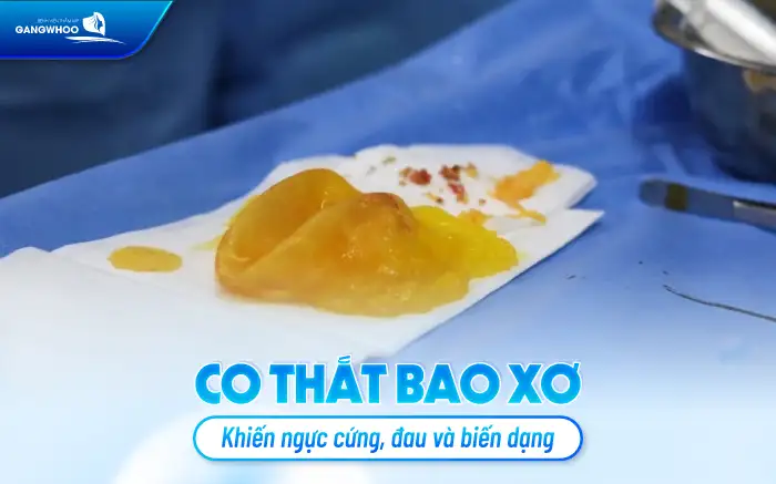 Nâng ngực bị biến chứng ra sao? Cách để hạn chế biến chứng khi nâng ngực